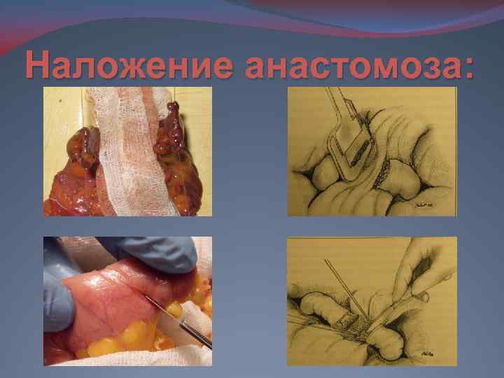 Наложение анастомоза: 