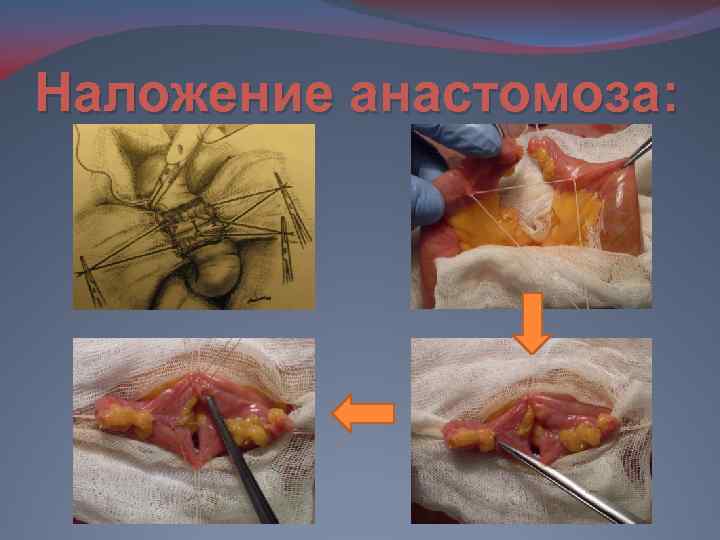 Наложение анастомоза: 