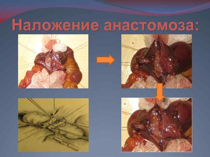 Наложение анастомоза: 