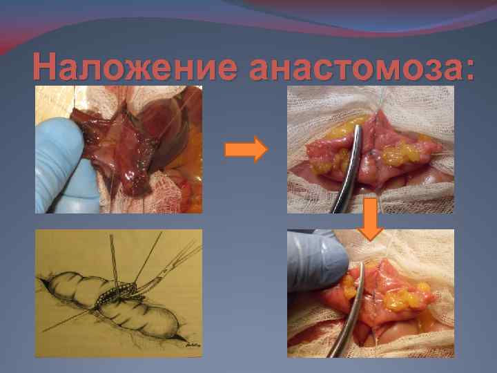 Наложение анастомоза: 