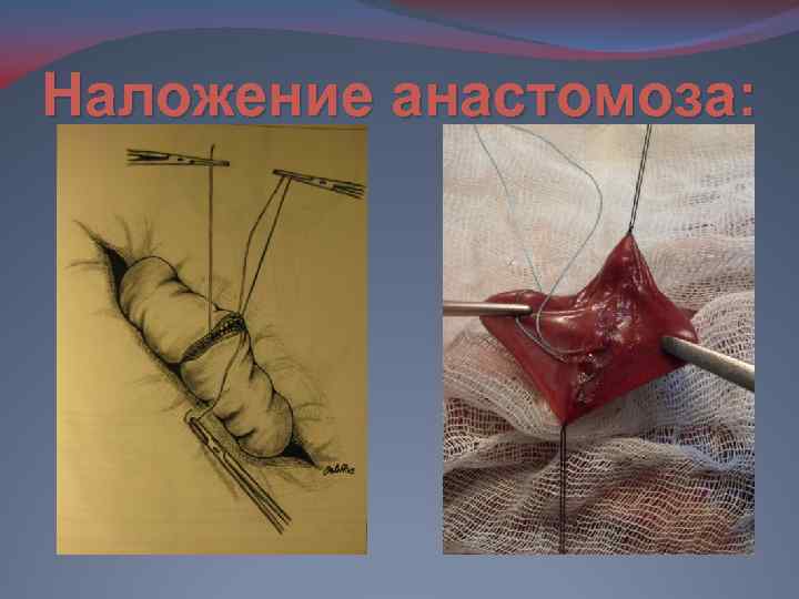 Наложение анастомоза: 