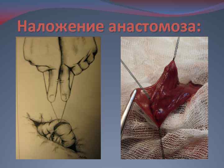 Наложение анастомоза: 