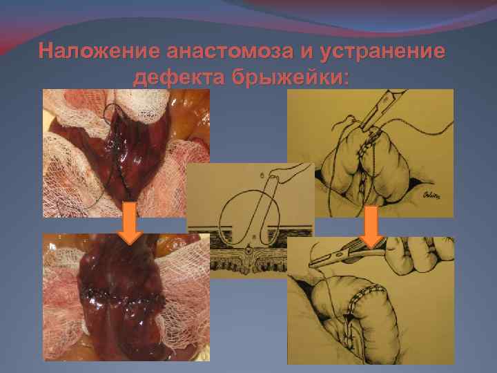 Наложение анастомоза и устранение дефекта брыжейки: 