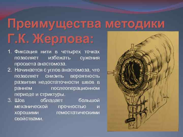 Преимущества методики Г. К. Жерлова: 1. Фиксация нити в четырех точках позволяет избежать сужения