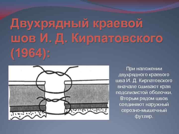 Двухрядный краевой шов И. Д. Кирпатовского (1964): При наложении двухрядного краевого шва И. Д.