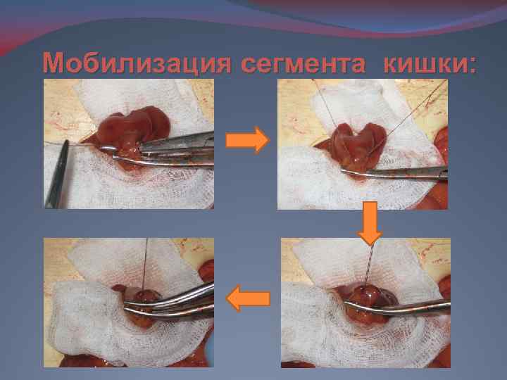 Мобилизация сегмента кишки: 