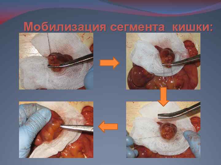 Мобилизация сегмента кишки: 