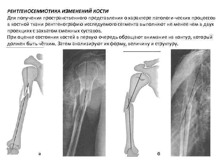 Изменения костей