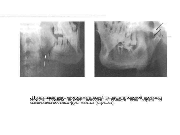 Проекция челюсти. Прицельная рентгенограмма нижней челюсти. Прицельная рентгенограмма нижней челюсти в боковой проекции. Перелом нижней челюсти в боковой проекции. Рентген нижней челюсти в боковой проекции.