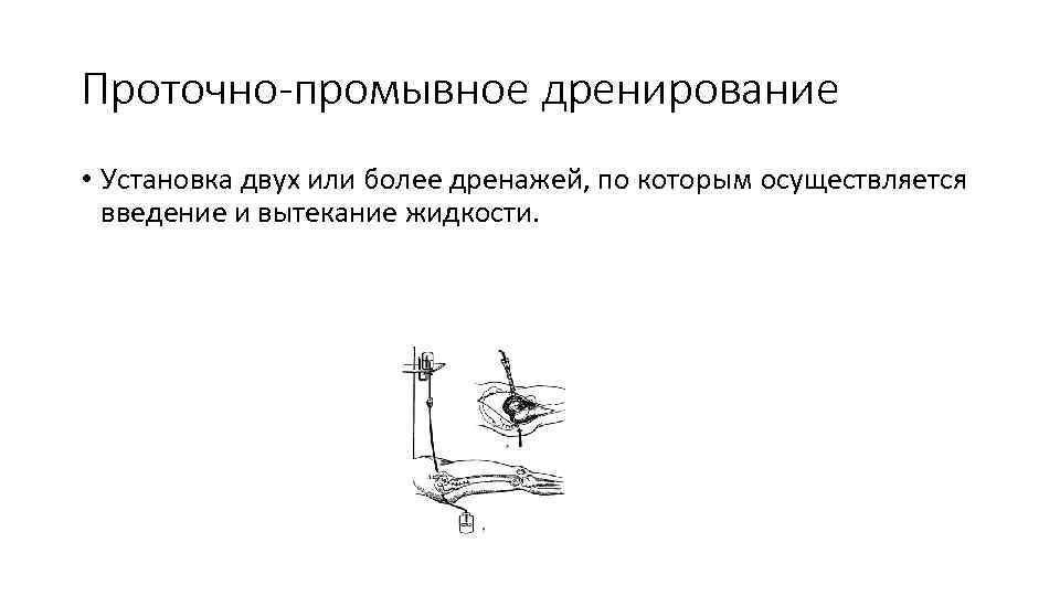 Проточно-промывное дренирование • Установка двух или более дренажей, по которым осуществляется введение и вытекание