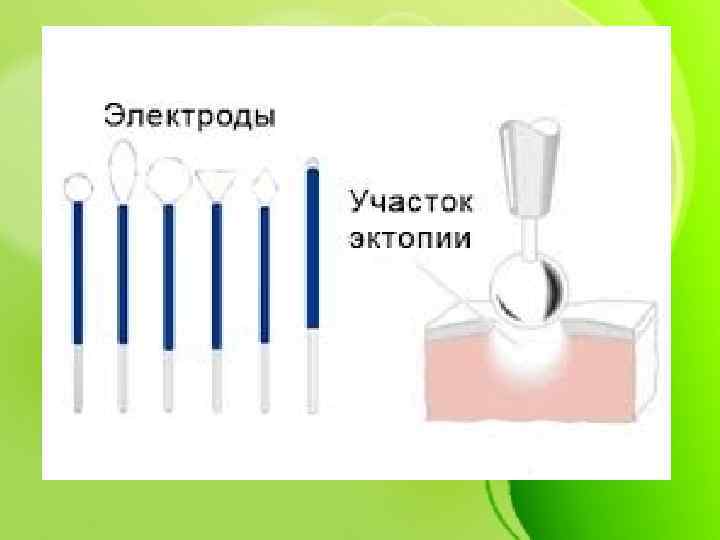 Радиоволновая шейки матки