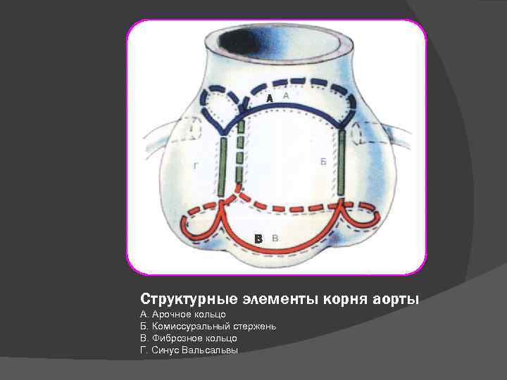 А В Структурные элементы корня аорты А. Арочное кольцо Б. Комиссуральный стержень В. Фиброзное