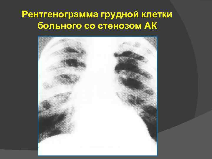 Рентгенограмма грудной клетки больного со стенозом АК 