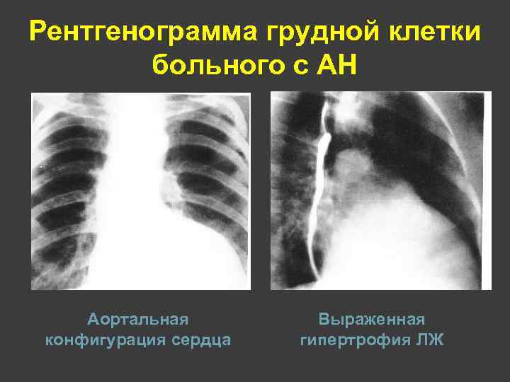 Рентгенограмма грудной клетки больного с АН Аортальная конфигурация сердца Выраженная гипертрофия ЛЖ 