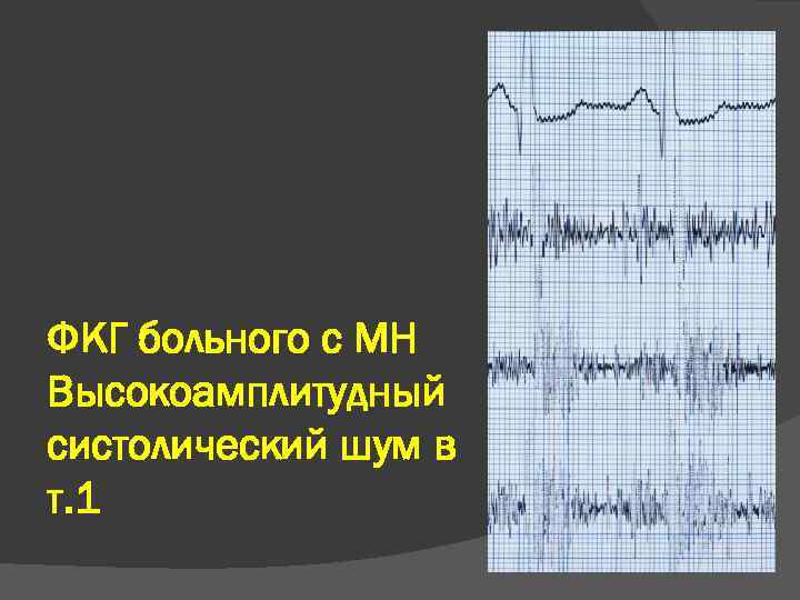 ФКГ больного с МН Высокоамплитудный систолический шум в т. 1 