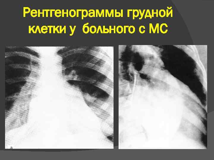 Рентгенограммы грудной клетки у больного с МС 