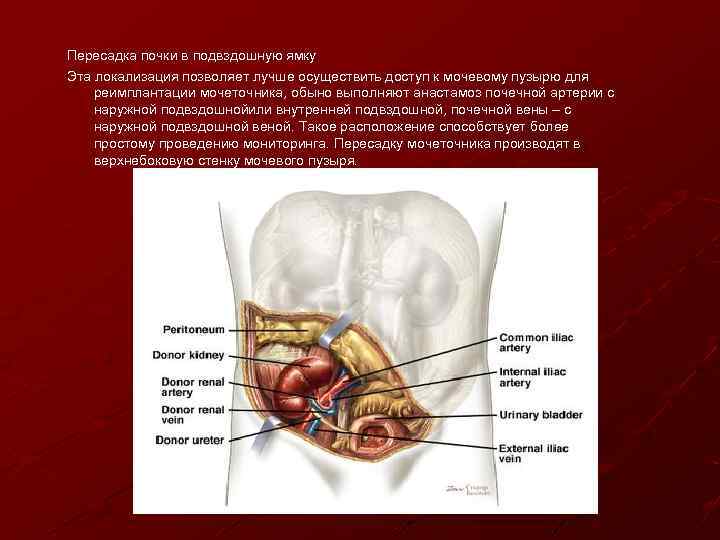 Пересадка почки в подвздошную ямку Эта локализация позволяет лучше осуществить доступ к мочевому пузырю