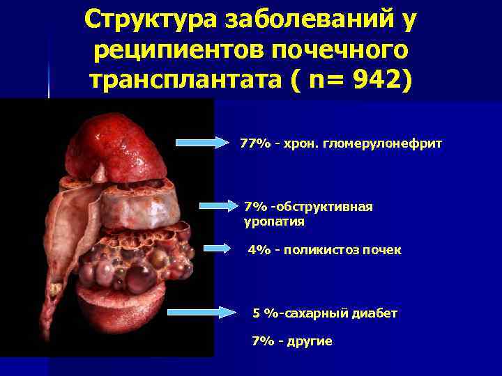 Структура заболеваний у реципиентов почечного трансплантата ( n= 942) 77% - хрон. гломерулонефрит 7%