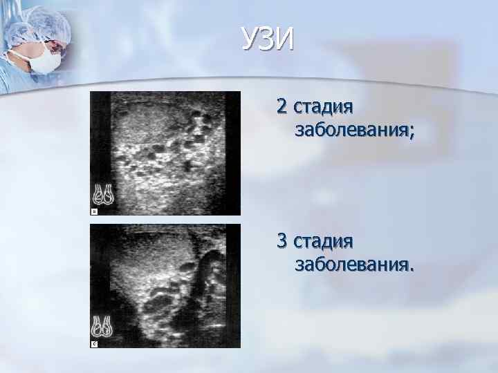 УЗИ 2 стадия заболевания; 3 стадия заболевания. 