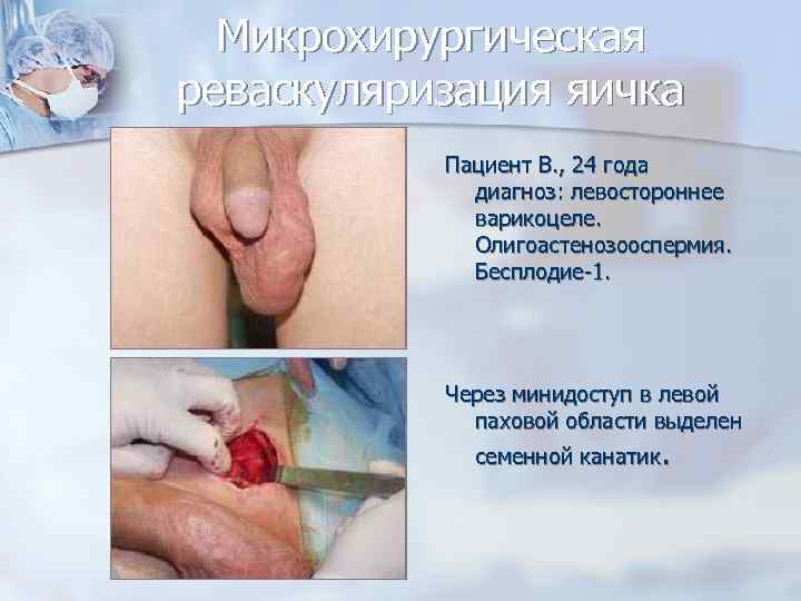 Микрохирургическая реваскуляризация яичка Пациент В. , 24 года диагноз: левостороннее варикоцеле. Олигоастенозооспермия. Бесплодие-1. Через
