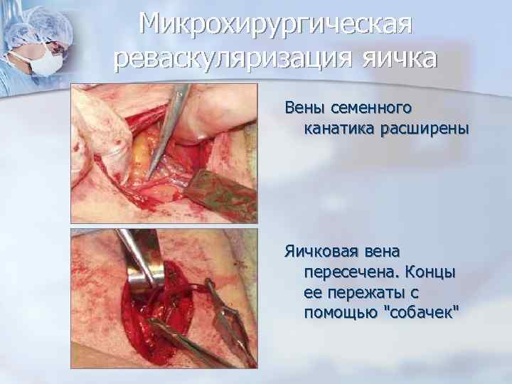 Микрохирургическая реваскуляризация яичка Вены семенного канатика расширены Яичковая вена пересечена. Концы ее пережаты с