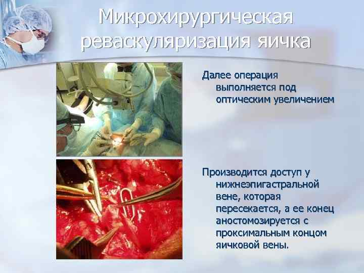 Микрохирургическая реваскуляризация яичка Далее операция выполняется под оптическим увеличением Производится доступ у нижнеэпигастральной вене,