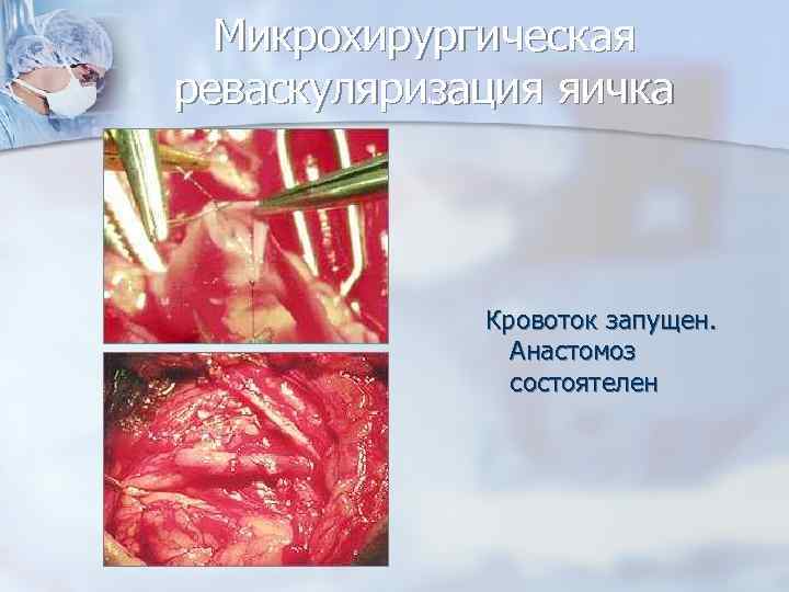 Микрохирургическая реваскуляризация яичка Кровоток запущен. Анастомоз состоятелен 