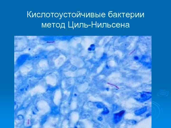 Кислотоустойчивые бактерии метод Циль-Нильсена 