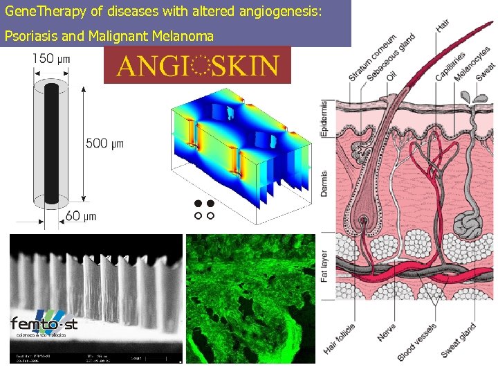 Gene. Therapy of diseases with altered angiogenesis: Psoriasis and Malignant Melanoma 