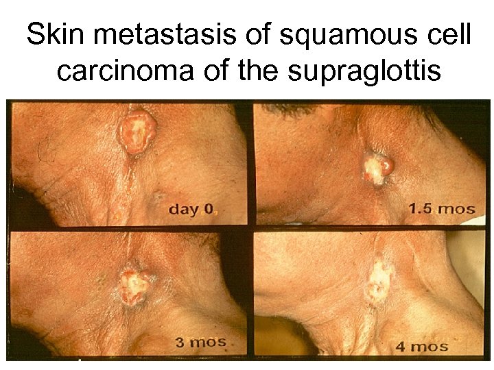 Skin metastasis of squamous cell carcinoma of the supraglottis 