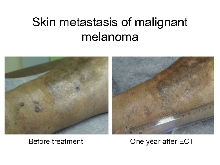 Skin metastasis of malignant melanoma Before treatment One year after ECT 
