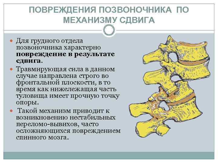 ПОВРЕЖДЕНИЯ ПОЗВОНОЧНИКА ПО МЕХАНИЗМУ СДВИГА Для грудного отдела позвоночника характерно повреждение в результате сдвига.