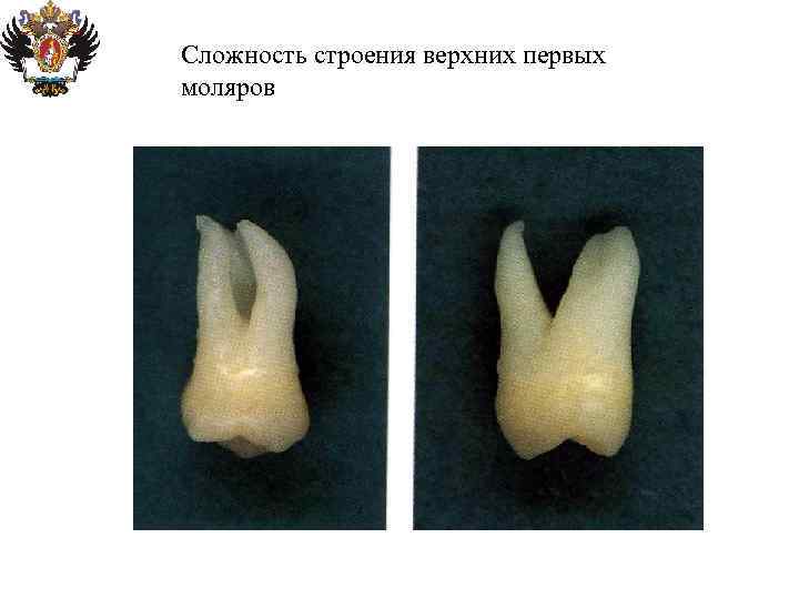 Сложность строения верхних первых моляров 
