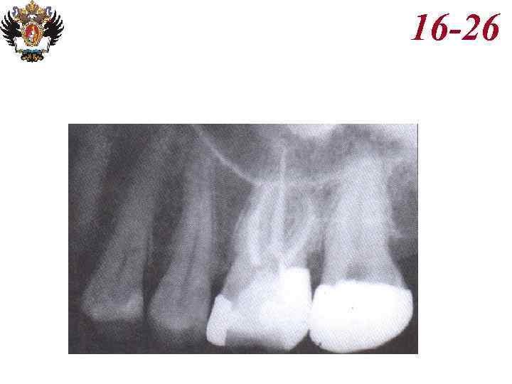 Анатомия корневых каналов презентация