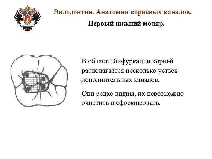 Эндодонтия. Анатомия корневых каналов. Первый нижний моляр. В области бифуркации корней располагается несколько устьев
