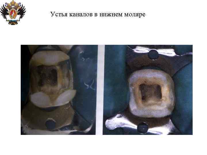 Устья каналов в нижнем моляре 