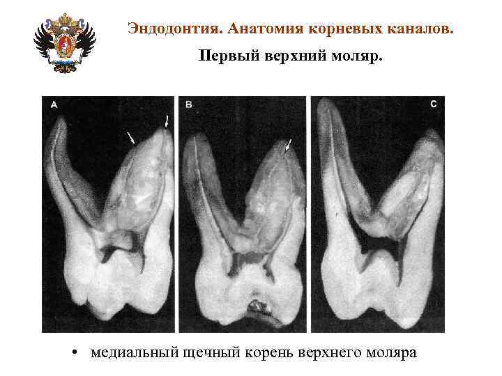 Эндодонтия. Анатомия корневых каналов. Первый верхний моляр. • медиальный щечный корень верхнего моляра 