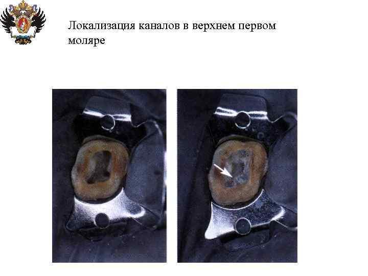 Локализация каналов в верхнем первом моляре 