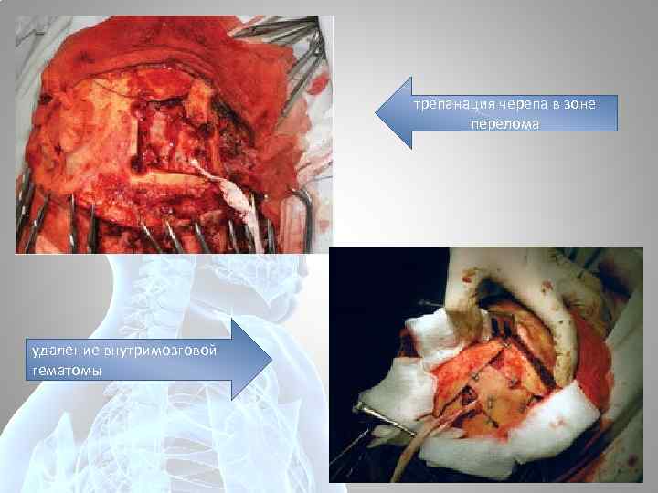 трепанация черепа в зоне перелома удаление внутримозговой гематомы 