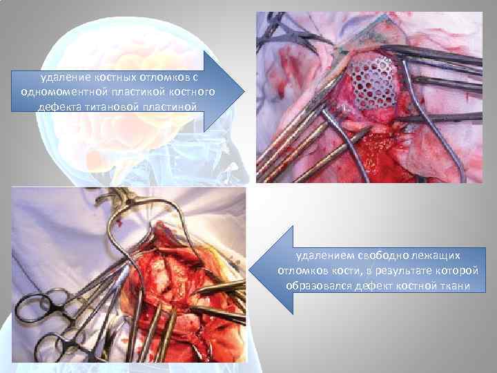  удаление костных отломков с одномоментной пластикой костного дефекта титановой пластиной удалением свободно лежащих