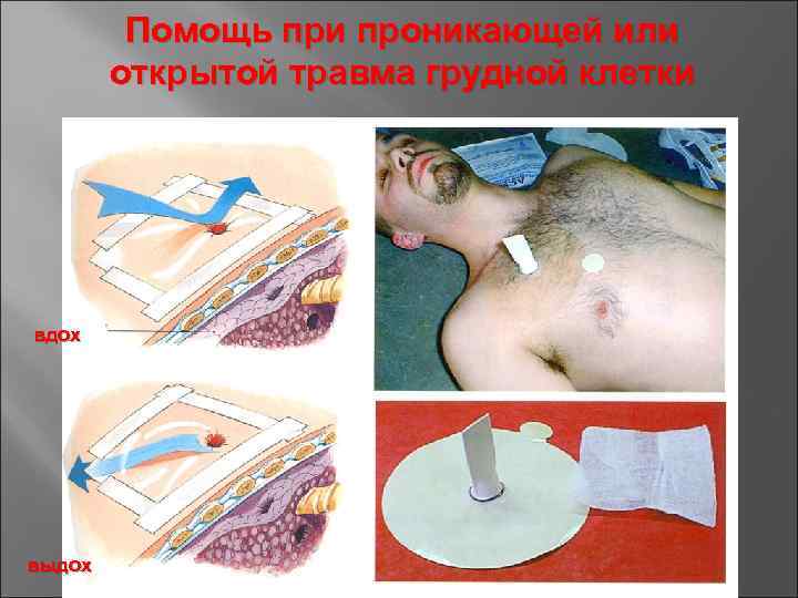 Помощь при проникающей или открытой травма грудной клетки вдох выдох 