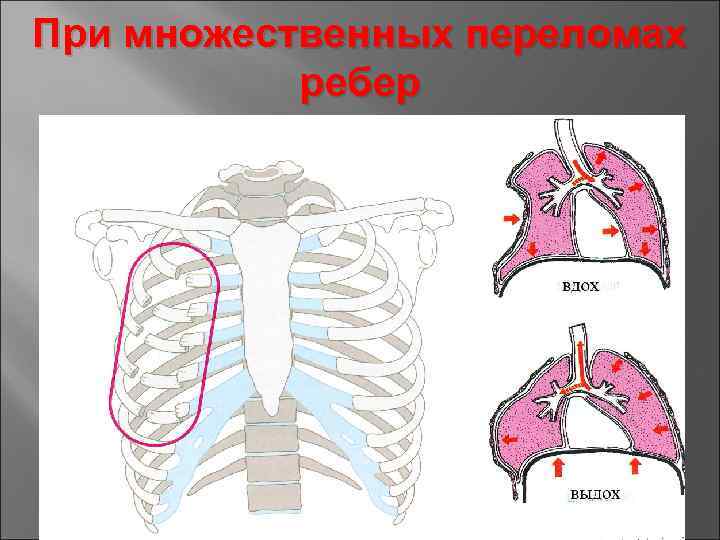 При множественных переломах ребер 