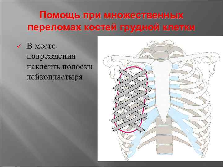 Помощь при множественных переломах костей грудной клетки ü В месте повреждения наклеить полоски лейкопластыря