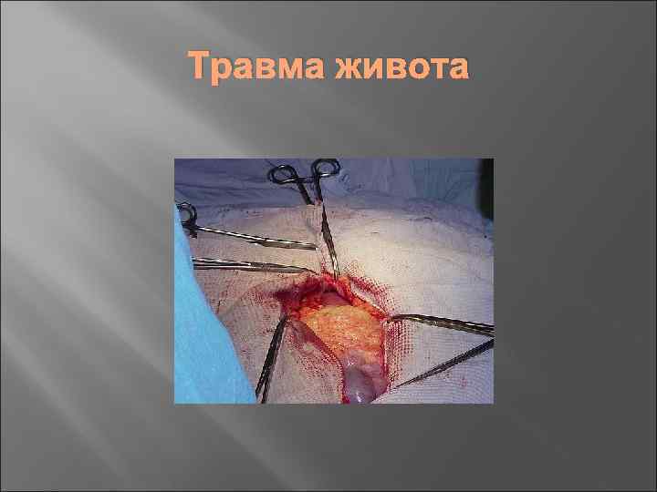 Травма живота 