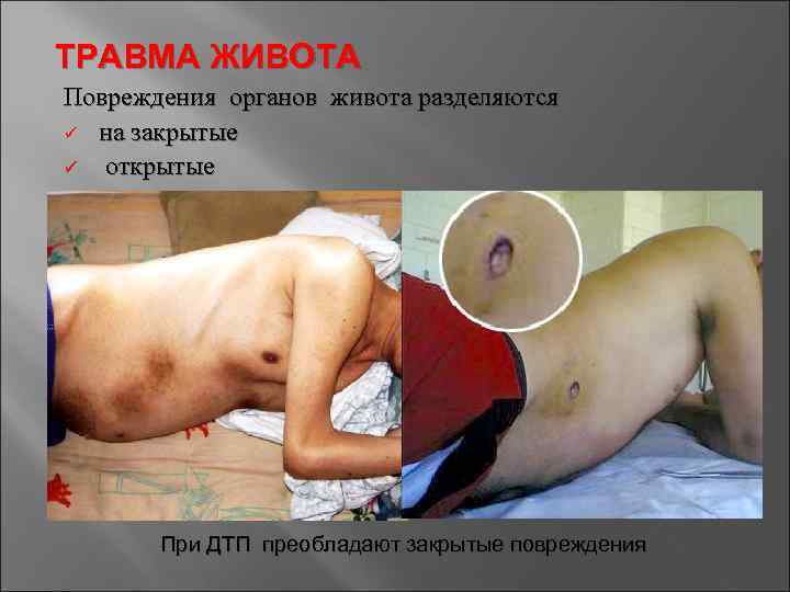 ТРАВМА ЖИВОТА Повреждения органов живота разделяются ü на закрытые ü открытые При ДТП преобладают
