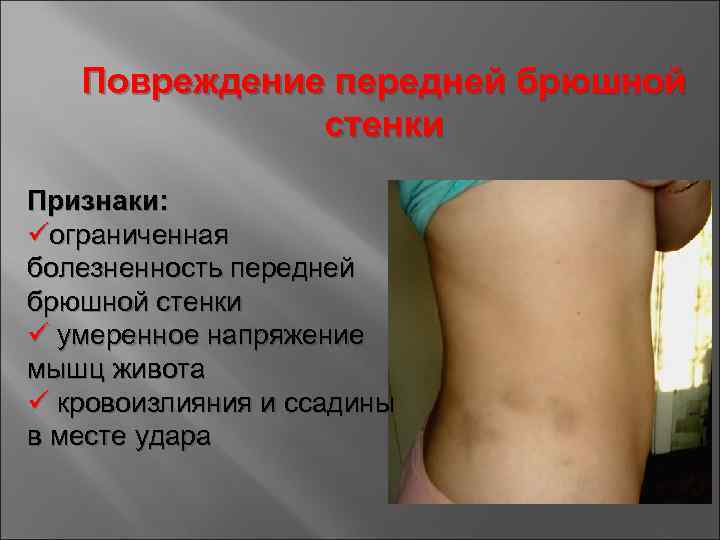 Повреждение передней брюшной стенки Признаки: üограниченная болезненность передней брюшной стенки ü умеренное напряжение мышц
