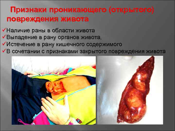Признаки проникающего (открытого) повреждения живота üНаличие раны в области живота üВыпадение в рану органов