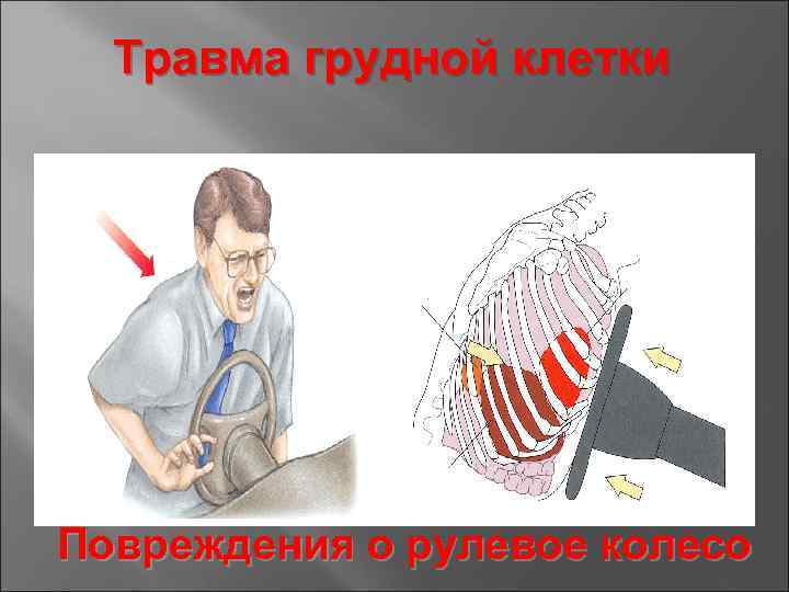 Травма грудной клетки Повреждения о рулевое колесо 
