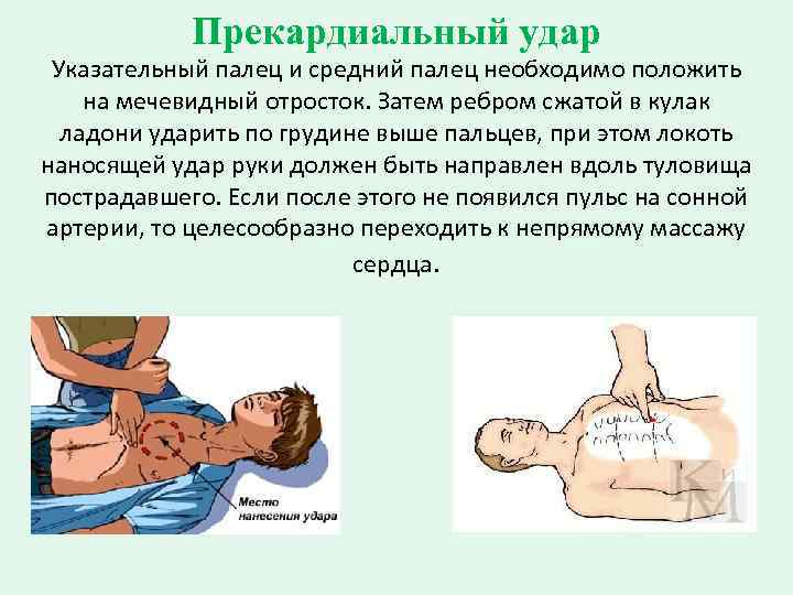 Прекардиальный удар Указательный палец и средний палец необходимо положить на мечевидный отросток. Затем ребром