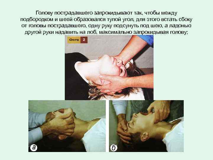 Голову пострадавшего запрокидывают так, чтобы между подбородком и шеей образовался тупой угол, для этого